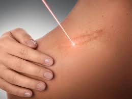 علاج الندبات بالليزر