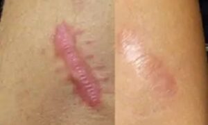 الندبات الجدرة