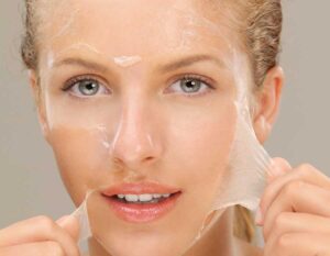 علاج الندبات بالتقشير الكيميائى